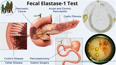 Fecal elastase, an assay for exocrine pancreatic insufficiency, has ...